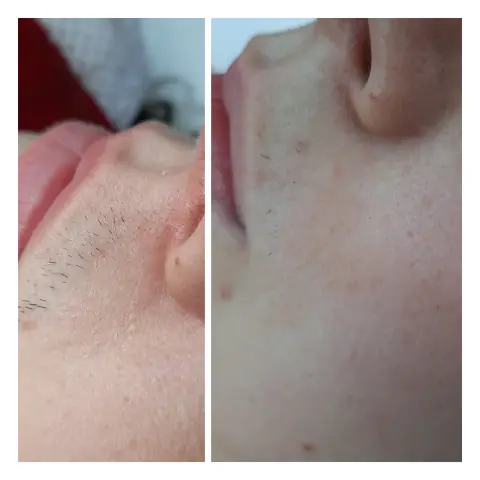 Epilare laser: în stânga înainte, în dreapta după