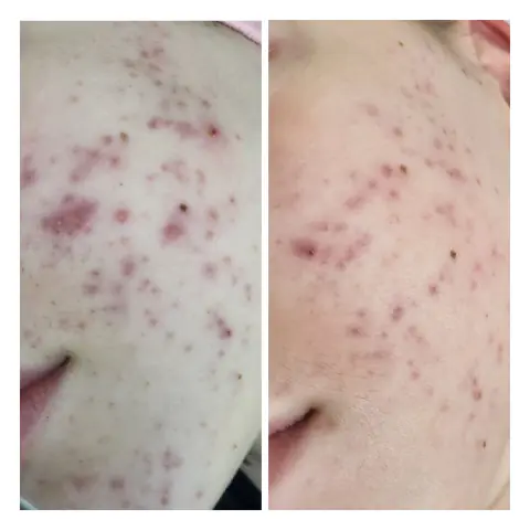Tratament acnee: în stânga înainte, în dreapta după
