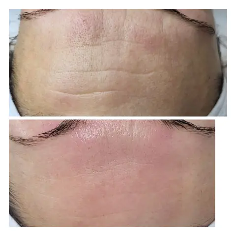 Tratament de biorevitalizare: în stânga înainte, în dreapta după