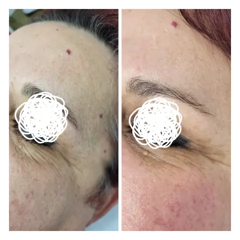 Tratament de biorevitalizare: în stânga înainte, în dreapta după
