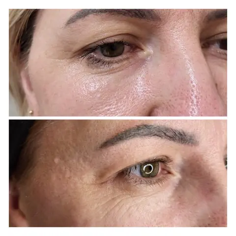 Plasma pen: în stânga înainte, în dreapta după