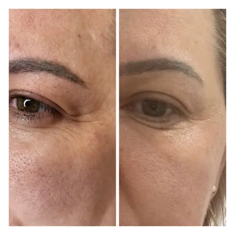 Plasma pen: în stânga înainte, în dreapta după
