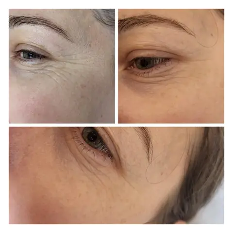 Tratament de biorevitalizare: în stânga înainte, în dreapta după