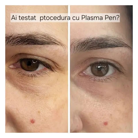 Plasma pen: în stânga înainte, în dreapta după