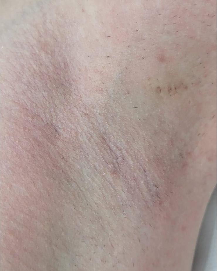 Epilare laser, axilă, după tratament