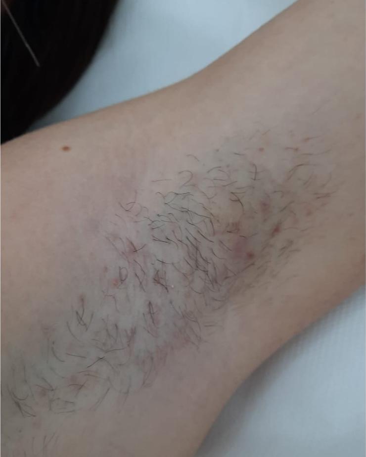 Epilare laser, axilă, înainte de tratament